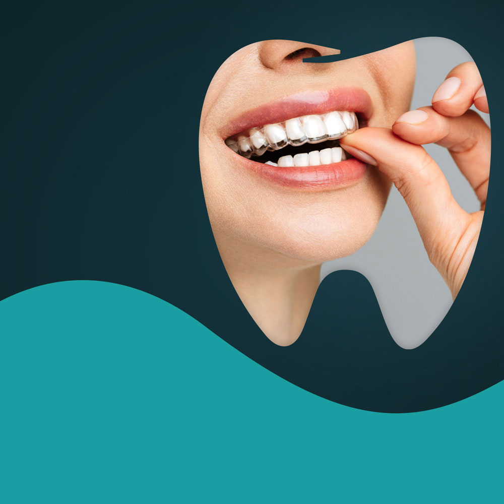 Invisalign treatment in Turkey can easily be applied in tooth crowding cases and split teeth problems called diastema in people who do not have complicated skeletal issues. It is a transparent plate maker named Invisalign after the words (invisible) and (aligner). You can reach us for your invisalign treatment in Turkey and get beautiful smile.