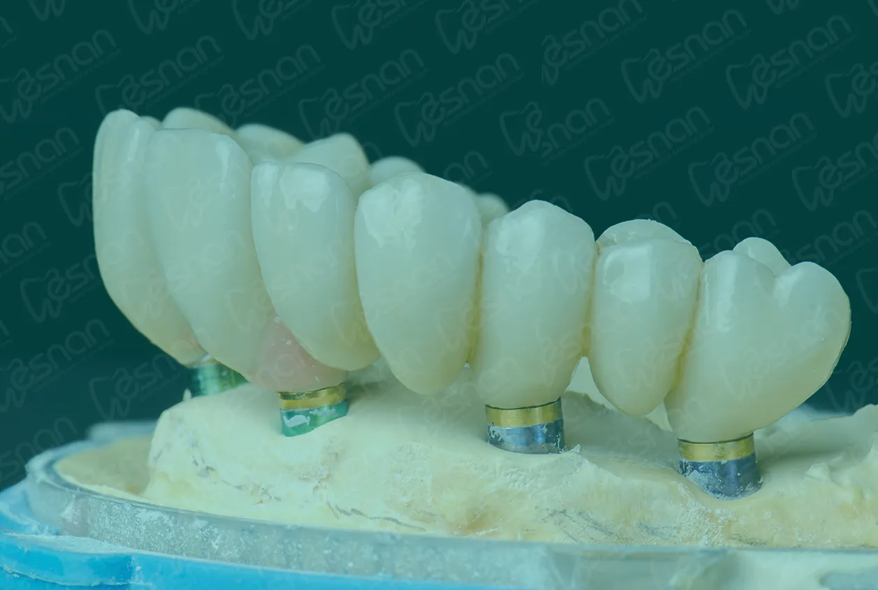Dental Crowns in Turkey Comparing Zirconia vs. Ceramic