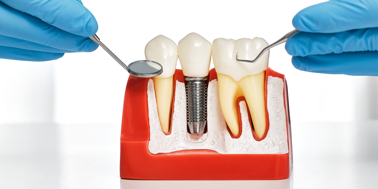Dental Implants in Turkey : A Comprehensive Guide to Costs and Benefits