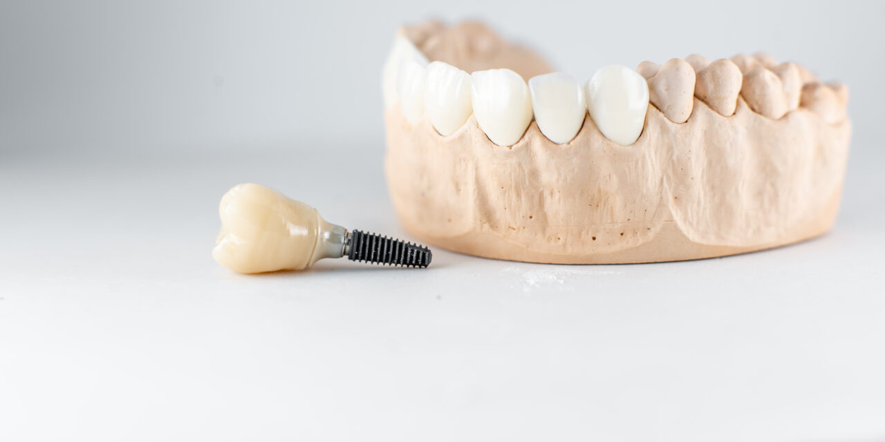 Affordable Dental Implants in Istanbul : World-Class Care