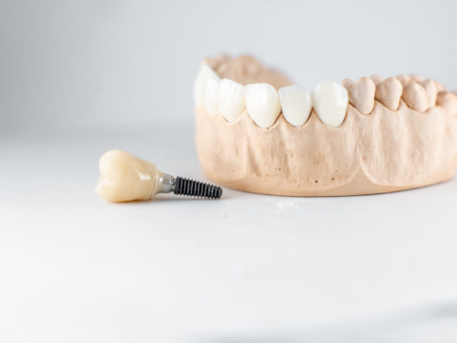 Affordable Dental Implants in Istanbul : World-Class Care