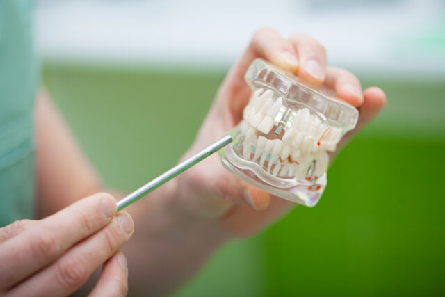 All-on-Six Implants in Istanbul