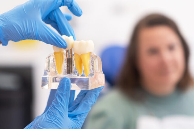 All-on-Six Implants in Istanbul
