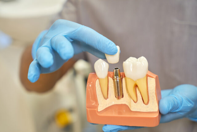 All-on-Six Implants in Istanbul