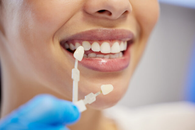 Turkey teeth journey with expert dentists 