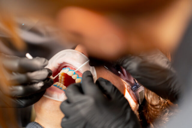 Transparent aligners used for orthodontic treatment in Istanbul to straighten teeth.