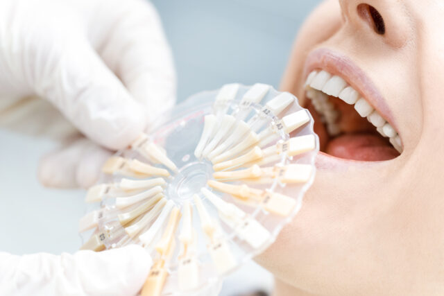 Before and after results of teeth whitening in Istanbul, showing a bright smile