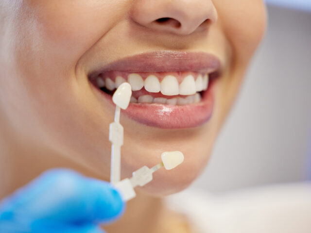 Veneers in Istanbul : Everything You Need to Know About Veneers Cost and Treatment