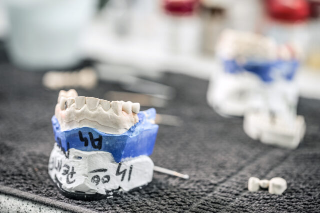 A perfect, stain-resistant porcelain veneer, showing the superior aesthetic in the 'composite bonding vs porcelain veneers' comparison.