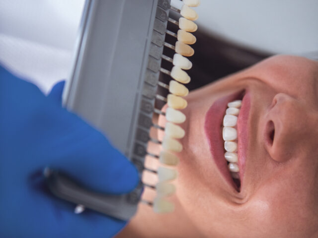 Composite Bonding: What You Should Know Before Choosing This Treatment