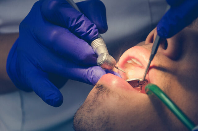 Root Canal Treatment in Istanbul