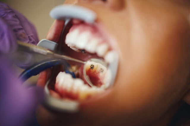 Gum Disease in Istanbul