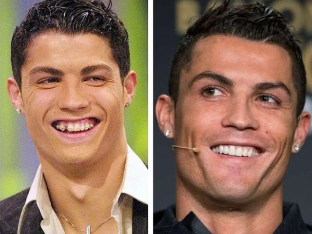 Cristiano Ronaldo Teeth: How Smile Aesthetics Can Change Over Time
