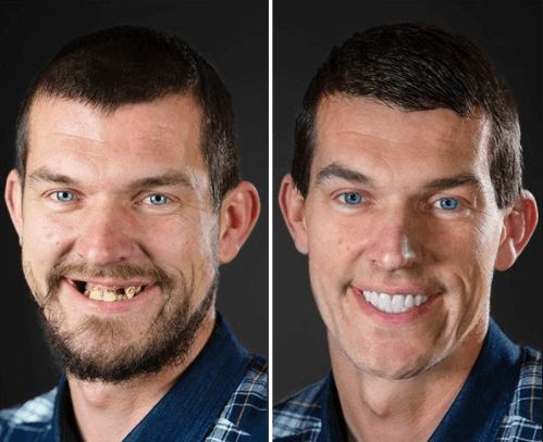 All on Eight İmplant