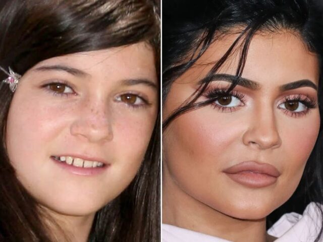Kylie Jenner Teeth: Smile Evolution and Cosmetic Dentistry Insights