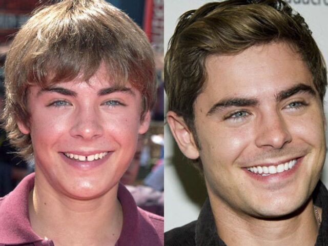 Zac Efron Teeth: Understanding Smile Changes and Dental Aesthetics