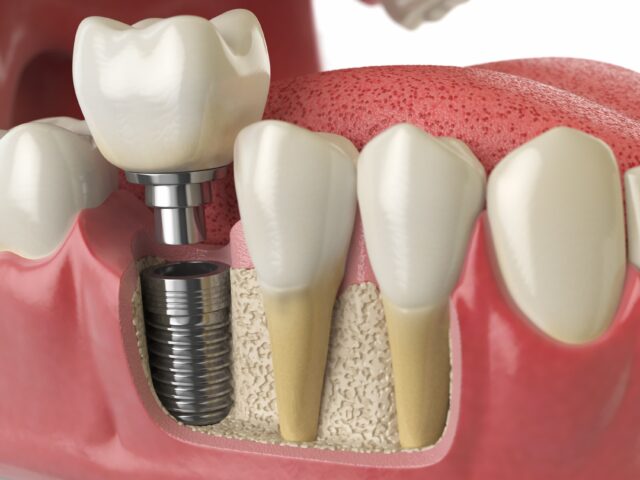 Dental Implant Molar Tooth: Costs and Process