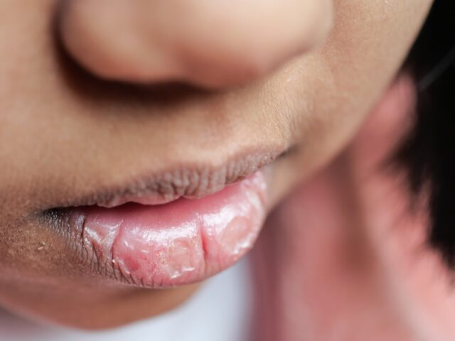 What Causes Dry Mouth at Night and How to Treat It?