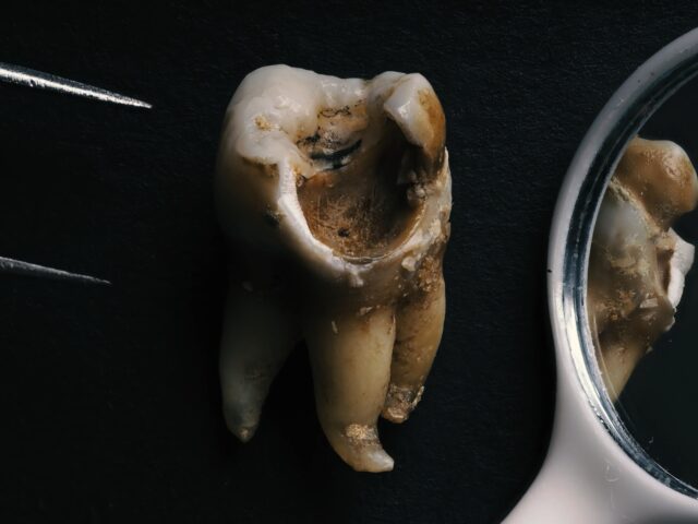 Tooth Infection Treatment: Causes, Treatment Methods, and Dental Care