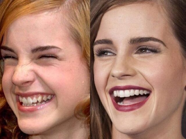 Emma Watson Teeth: A Journey from Childhood to Red Carpet Elegance
