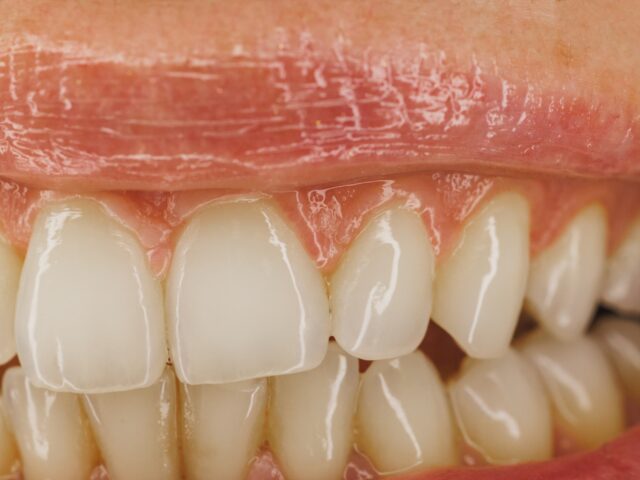 How to Treat Swollen Gums: Causes, Symptoms, and Solutions