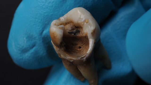 dental erosion