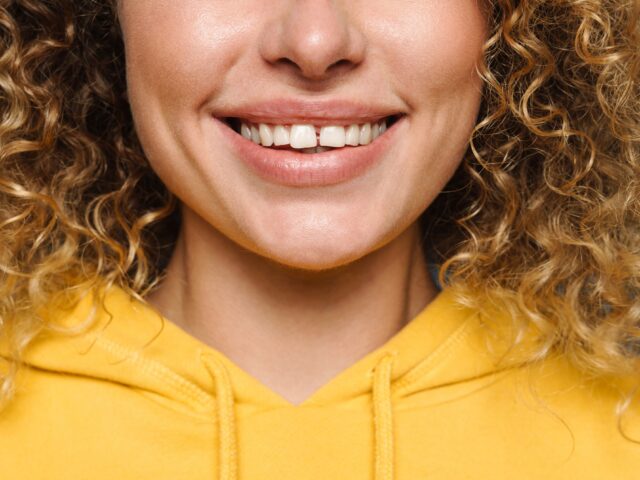 Diastema (Gapped Teeth): Causes, Treatments, and Closing the Gap