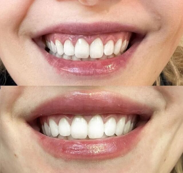 gummy smile correction