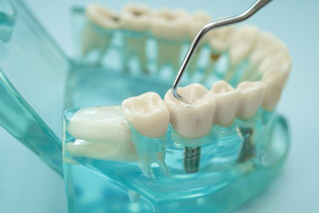 implant sonrası beslenme