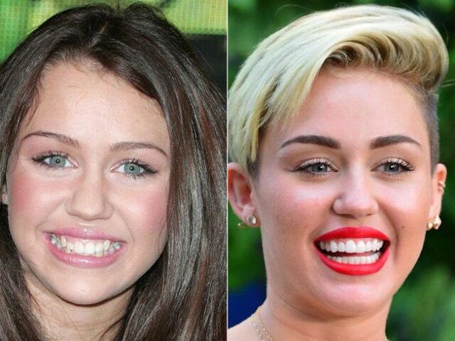 Miley Cyrus Teeth Transformation: From Gummy Smile to Hollywood Icon