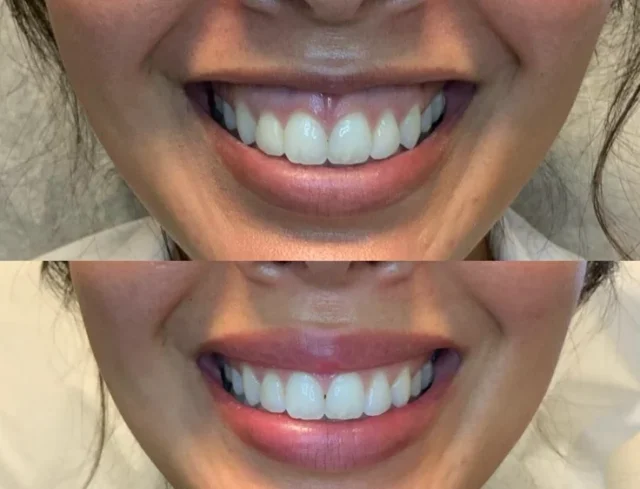 gummy smile correction