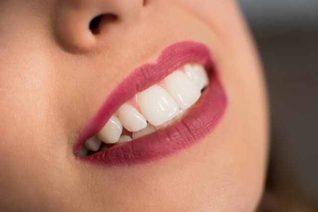 dental veneers