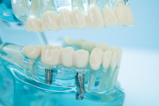 all on four dental implants
