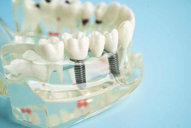 all on 8 dental implants