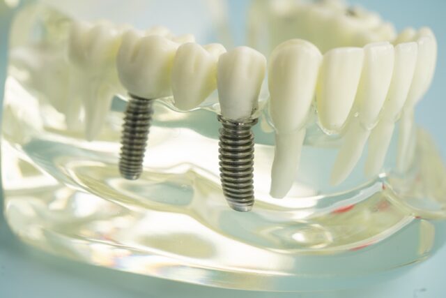 all on four dental implants