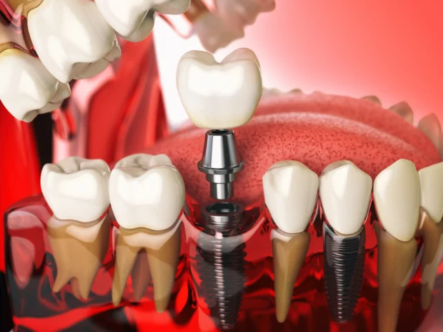 dental implants turkey cost