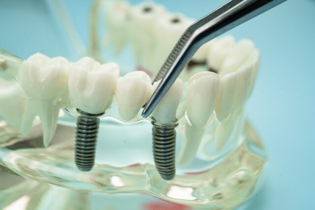 all on 6 dental implants