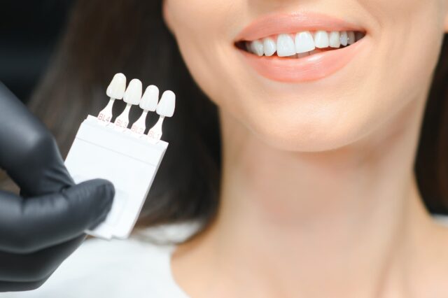 dental veneers