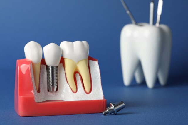 all on 6 dental implants