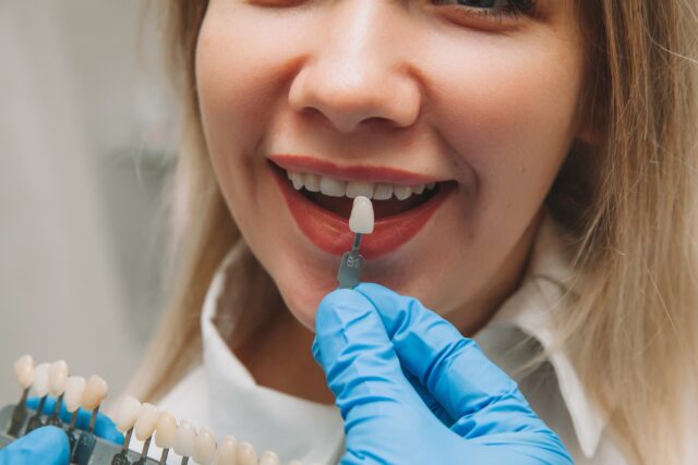 laminate veneers