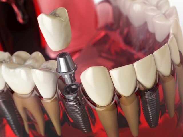 all on 8 dental implants