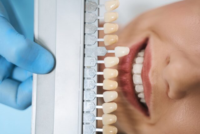 laminate veneers