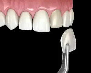 veneers istanbul cost