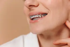 clear aligners vs traditional braces