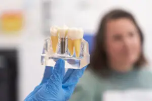 dental implant molar tooth