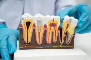 dental implant molar tooth