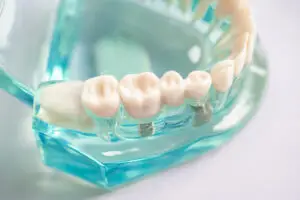 zirconia vs monolithic zirconia