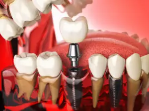 dental implant molar tooth