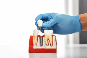 all on 4 vs all on 6 dental implants