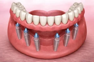 dental implants turkey